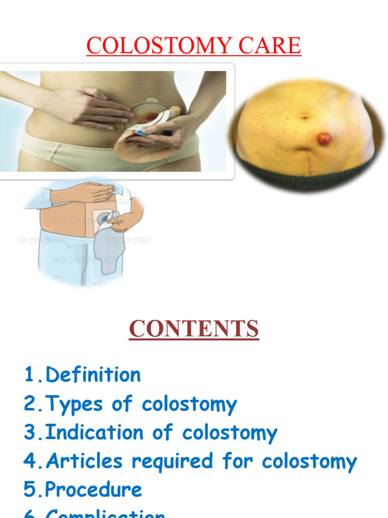 Colostomy Care Pdf Clinical Medicine Gastroenterology