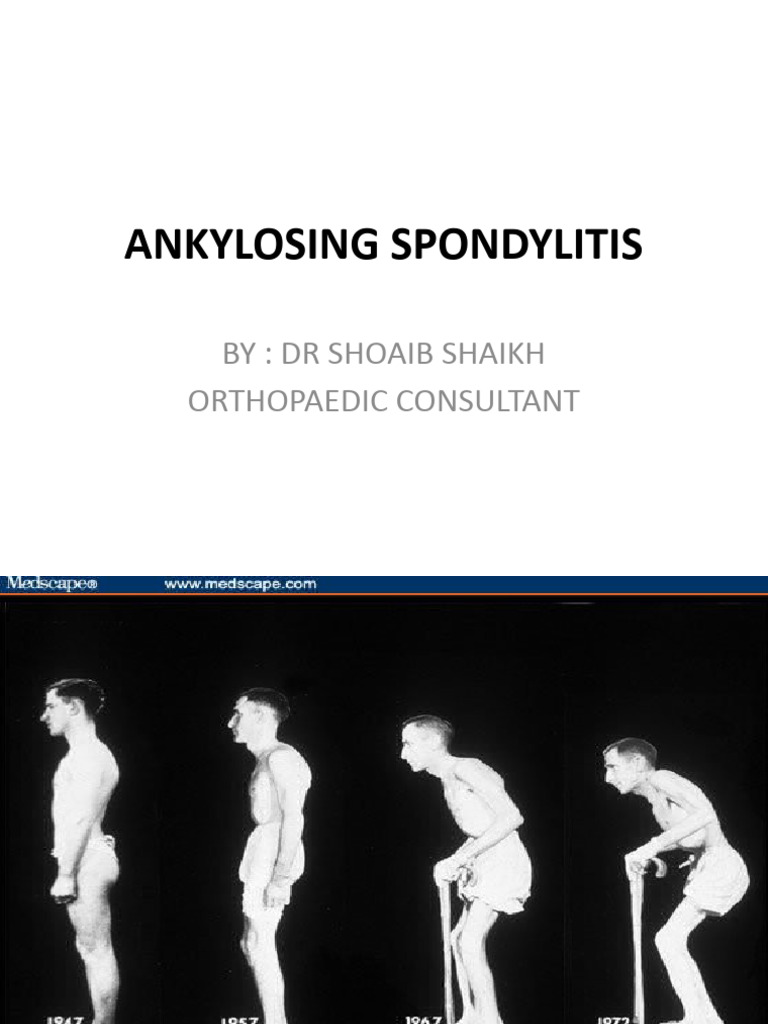 Ankylosing Spondylitis Overview | PDF | Vertebral Column | Skeletal System