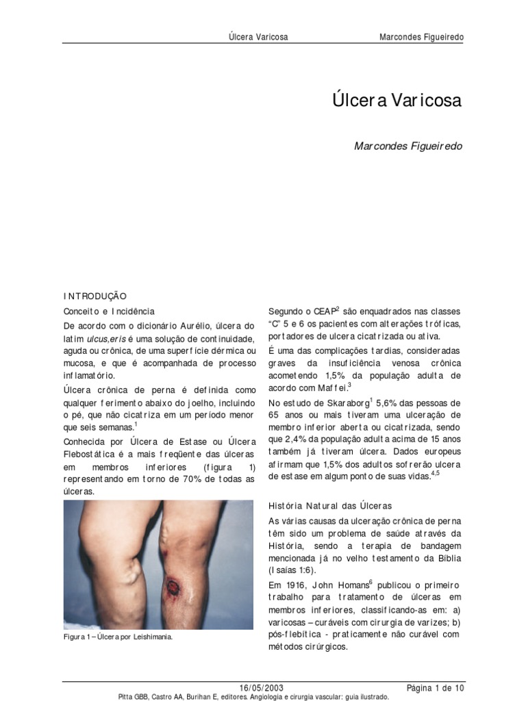 Artigo Úlcera Varicosa | PDF