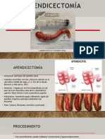 Apendicectomía Laparoscópica y Convencional