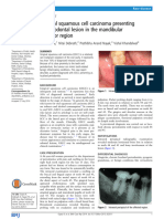 Gingival Squamous Cell Carcinoma Presenting As Periodontal Lesion in The Mandibular Posterior Region