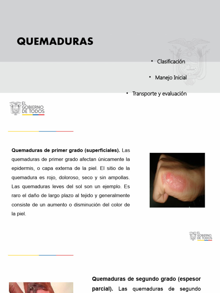 Clasificación y Manejo de Quemaduras | PDF | Quemar | Piel
