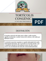 Tortícolis Congènica