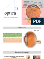 Neuritis Óptica