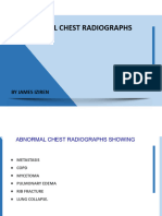 Abnormal Chest Radiographs