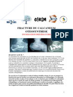 Fracture Calcaneum