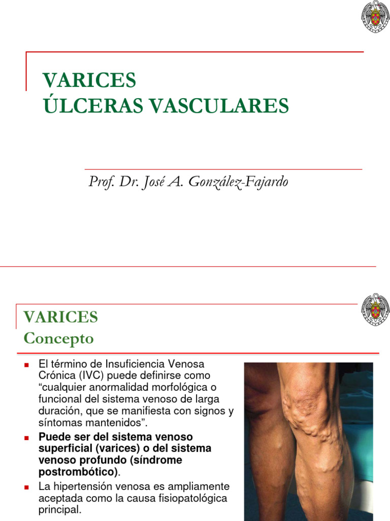 Venas Varicosas Varices Gpc _ Úlceras vasculares venosas. Artículo ...