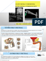 Estrechez Uretral