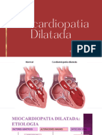 Miocardiopatia Dilatada