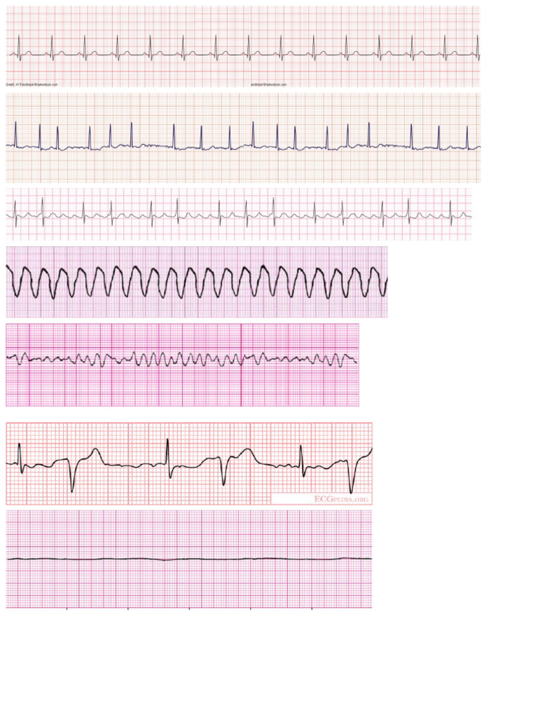 ECG Strips Print PDF ECG Strips Print PDF