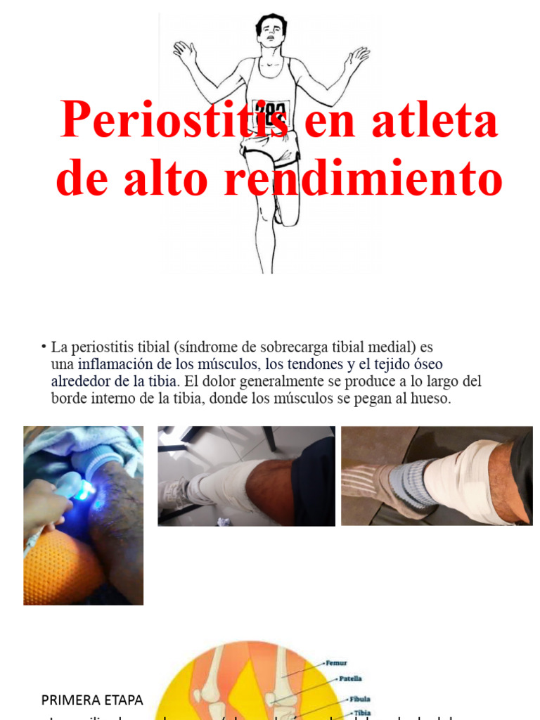 Periostitis en atletas de alto rendimiento | PDF