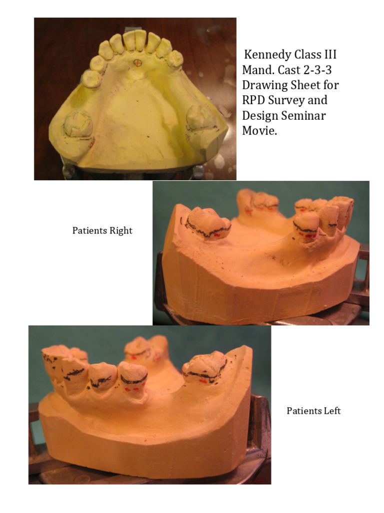 RPD Survey and Design Seminar Drawing | PDF