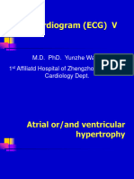 5hypertrophy and MI