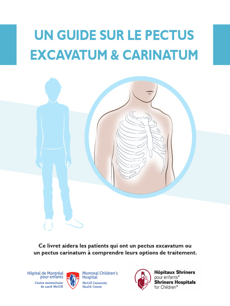 Guide sur le Pectus Excavatum et Carinatum | PDF | Chirurgie | Douleur