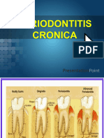 Periodontitis Cronica