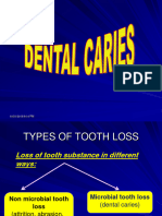 Dental Caries