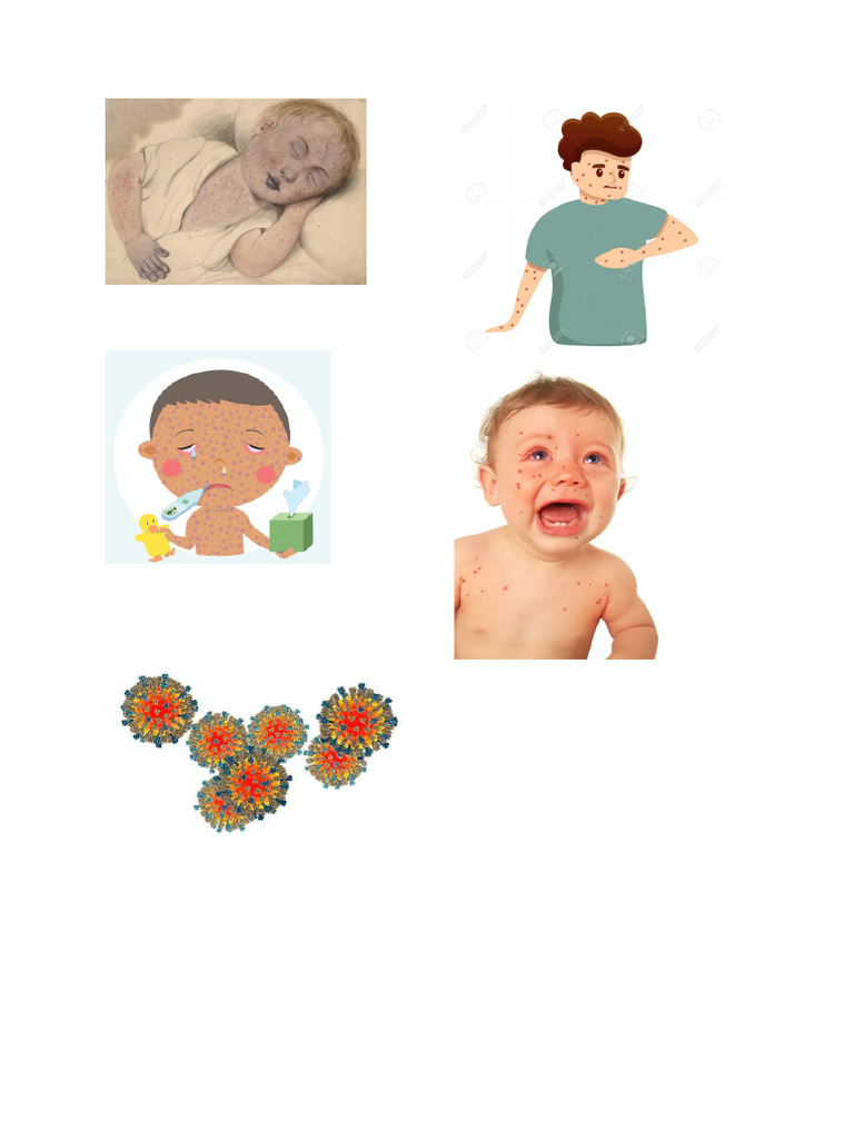 Sarampion Imagenes Pdf