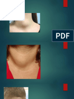 Midline Neck Swelling