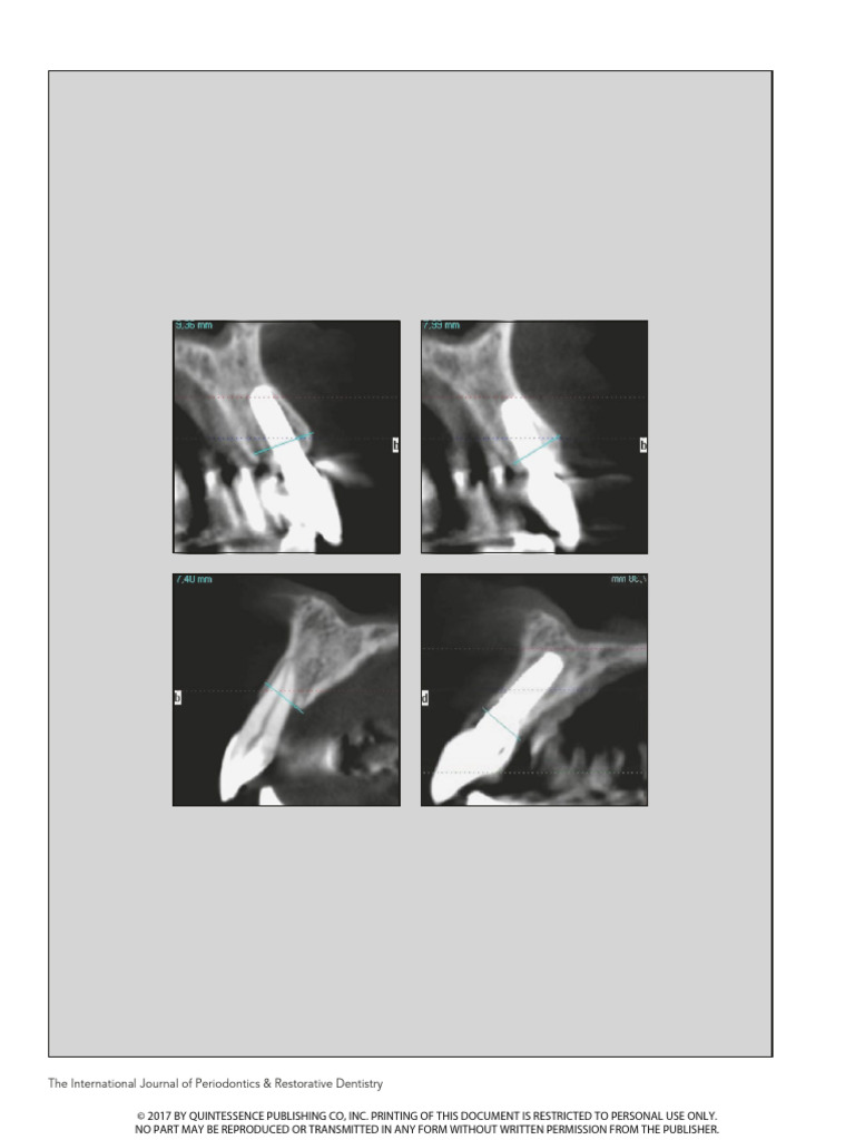 Buccal-Lingual Bone Remodeling in Immediately Loaded Fresh Socket ...