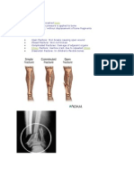 What is Fracture-fred