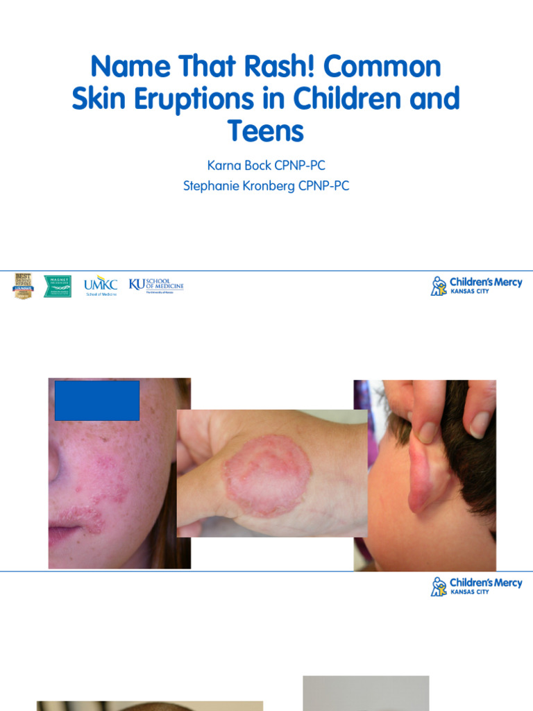 Name That Rash Common Skin Eruptions in Children | Download Free PDF ...