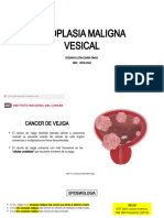 Neoplasia Maligna Vesical - EXPO