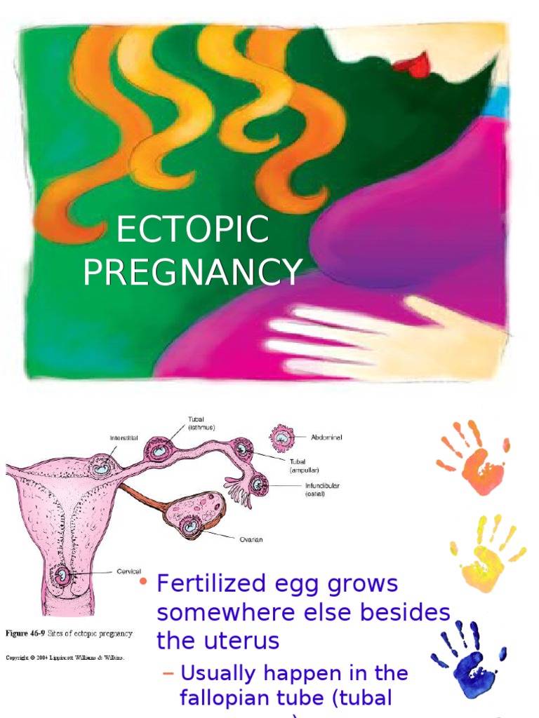 Ectopic Pregnancy | PDF | Fertility | Pregnancy