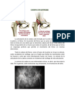 Artrosis de Cadera (Coxartrosis)