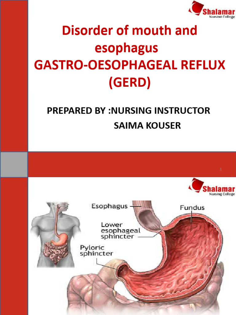 GASTRO-OESOPHAGEAL REFLUX | PDF | Gastroesophageal Reflux Disease ...