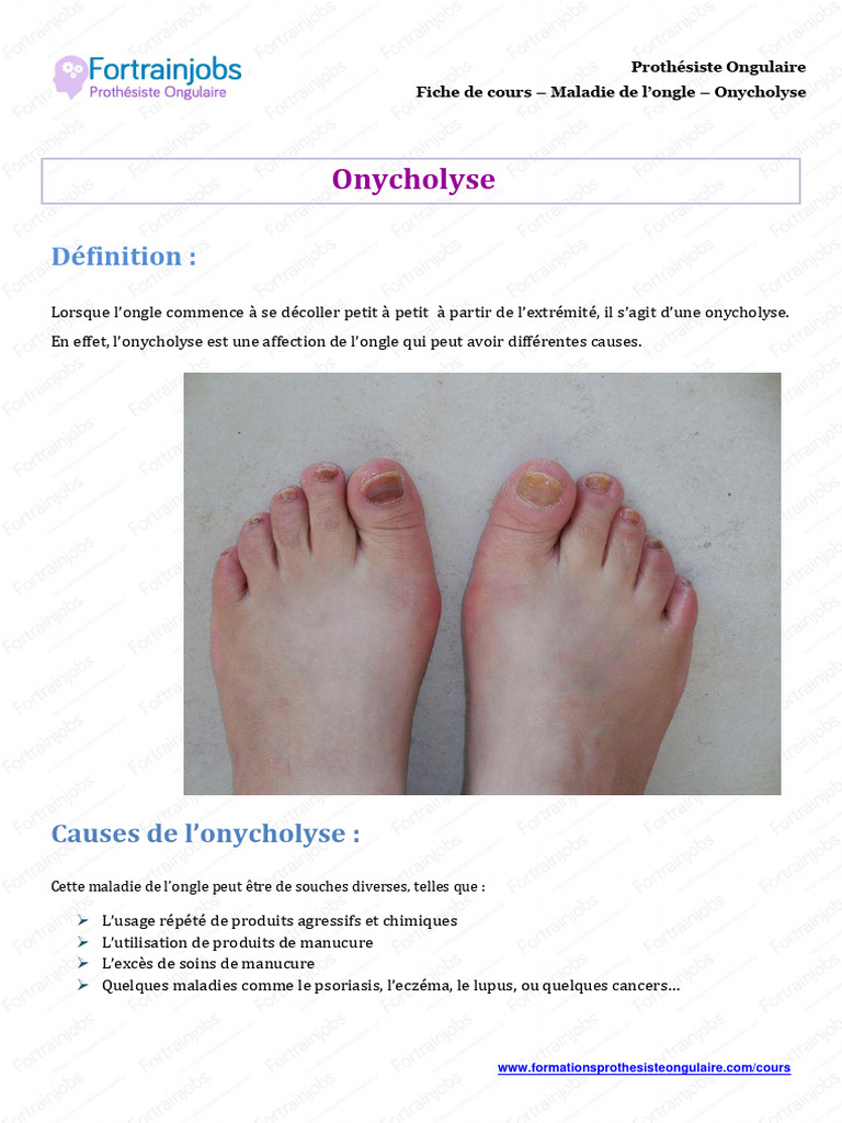 Onycholyse Causes et traitements PDF Ongle Psoriasis — free download
