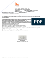 Modalidad Tomografia: Se Realiza Angio TC de Aorta Toráxica Con Reconstrucción Multiplanar Evidenciado