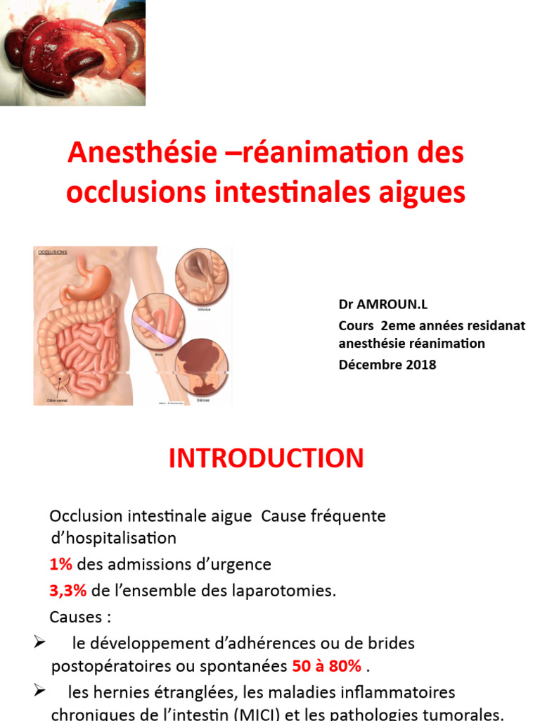 19. Anesthesie reanimation occlusion intestinale aigue | PDF ...