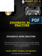 Zygomatic Bone Fracture