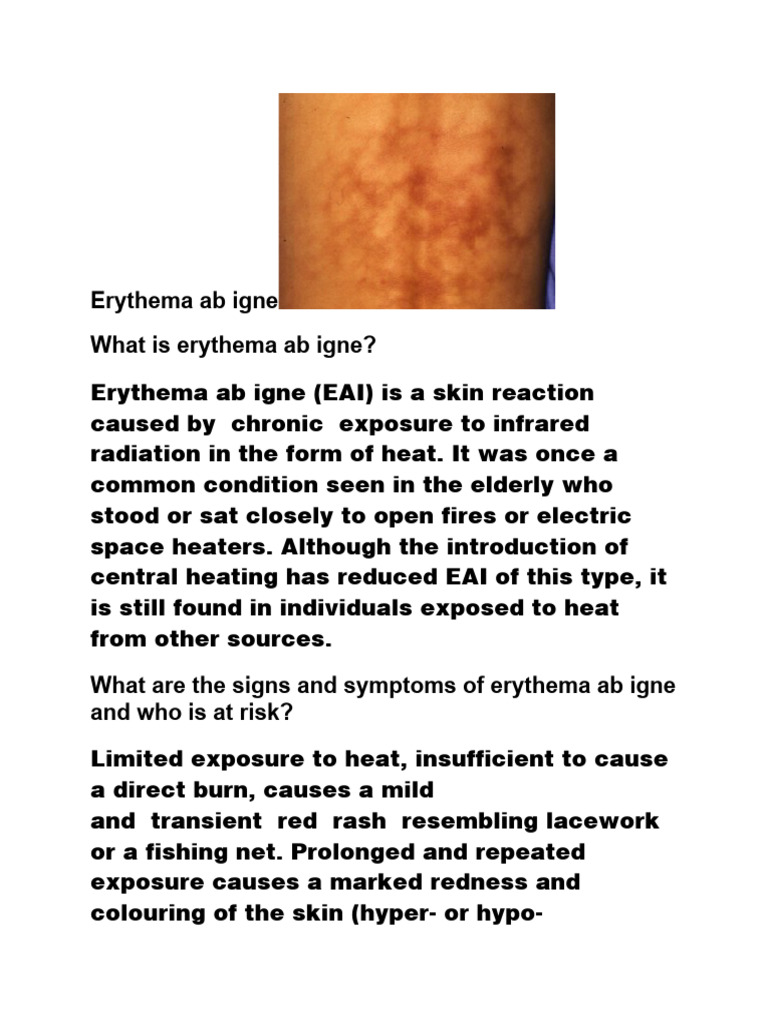 Erythema ab igne PDF