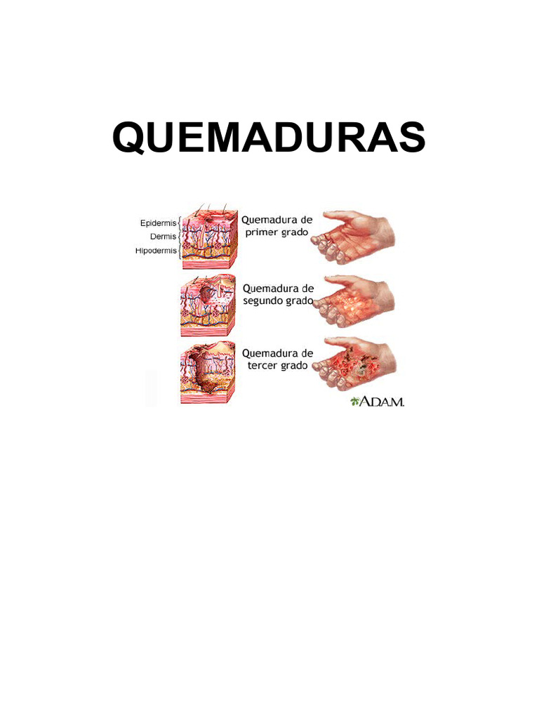 Tratamiento y Manejo de Quemaduras | PDF | Herida | Quemar