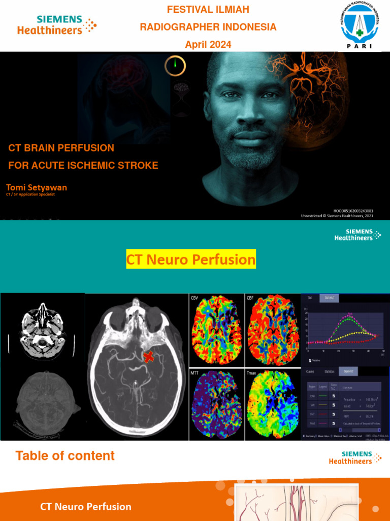 CT Brain Perfusion in Stroke Diagnosis | PDF | Stroke | Speech