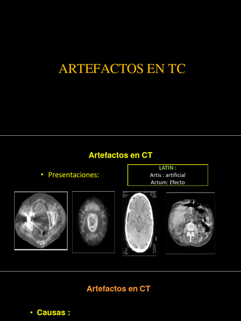 Tipos Y Causas De Artefactos En TC PDF
