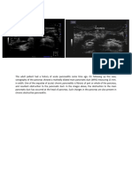 15-Dilatation of MPD (Main Pancreatic Duct) - Complication of Acute Pancreatitis