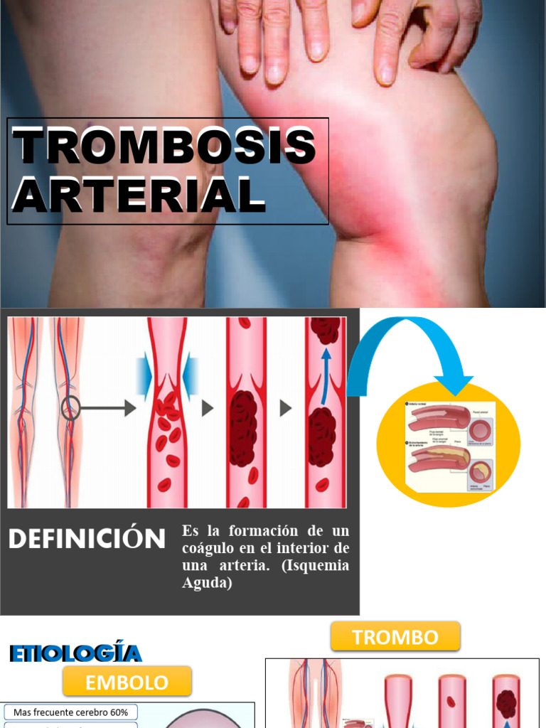 Trombosis Arterial: Guía Médica | PDF