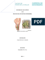 Osteomielitis Crónica