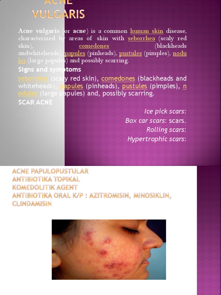 Acne Vulgaris (Or Acne) Is A Common PDF Acne Vulgaris Drugs