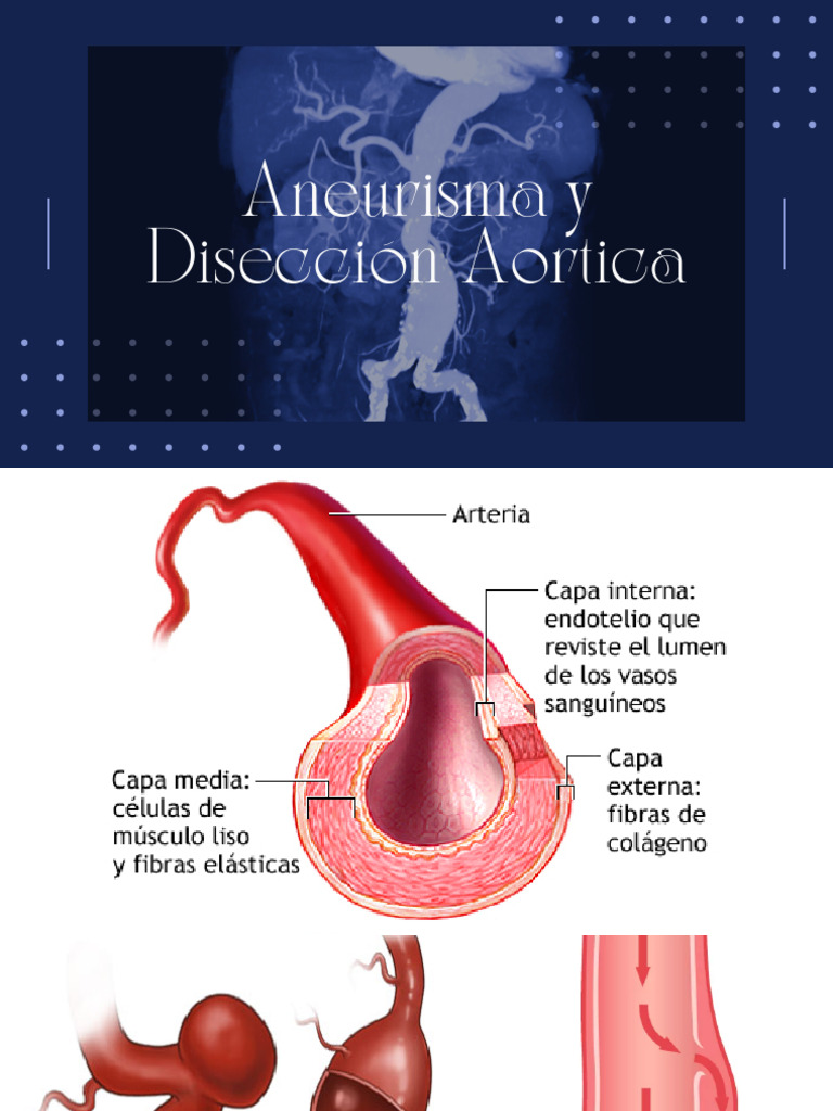 ANEURISMA | PDF