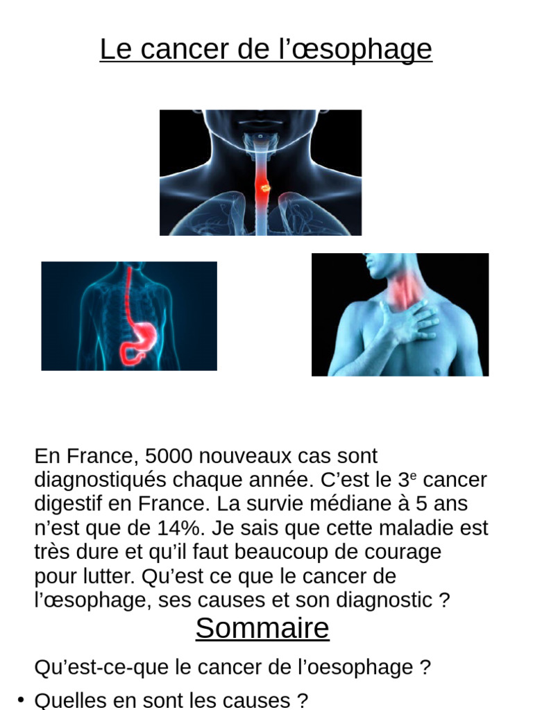 Cancer de l'œsophage causes et diagnostics PDF Cancer de l — free download