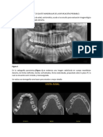 Caso Clinico N° 25 QUISTE MANDIBULAR DE LA BIFURCACIÓN (PROBABLE)