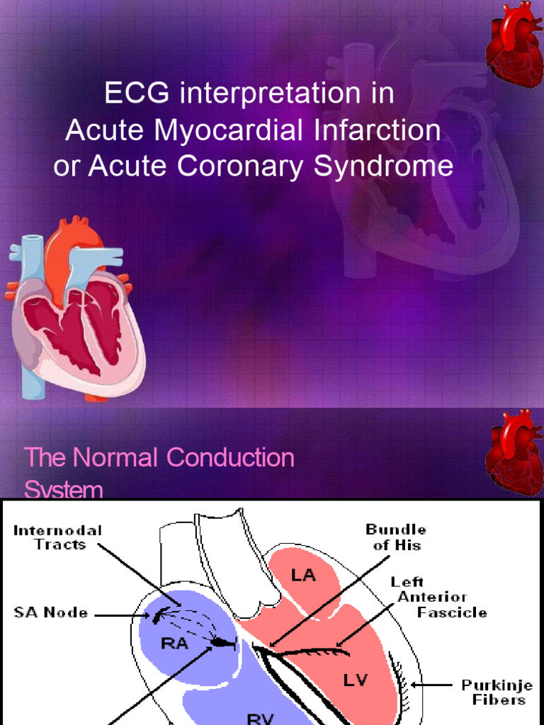 ECG Interpretation in Acute Myocardial Infarction | PDF ...