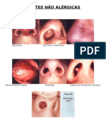 FOTOS Rinites Não-Alérgicas