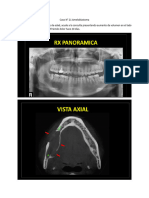 Caso N° 21 Ameloblastoma