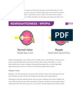 Myopia Causes