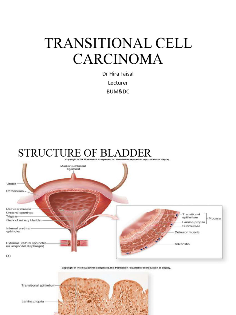 Transitional Cell Carcinoma | PDF | Medical Specialties | Neoplasms