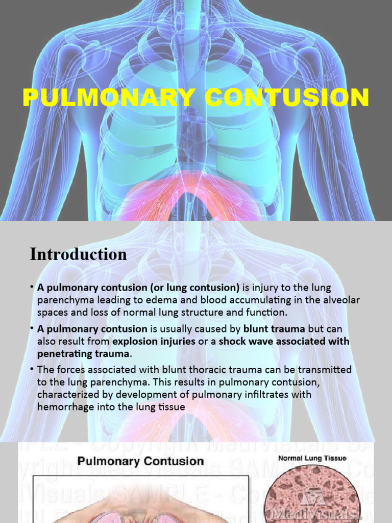 Understanding Pulmonary Contusion: Causes & Management | PDF | Clinical ...